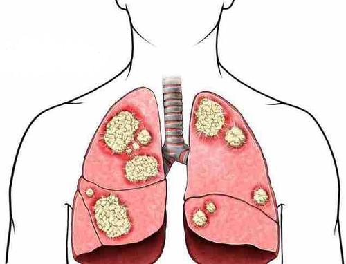 肺大泡可以吸电子烟吗