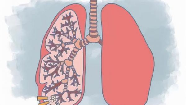 做了肺大泡手术能抽电子烟吗？