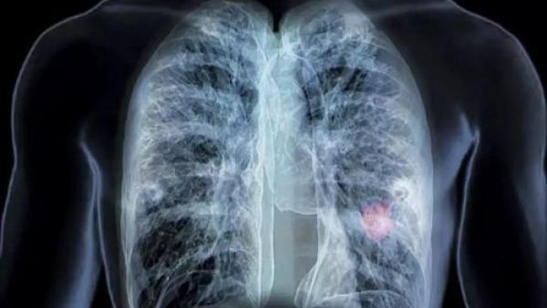 肺部手术后可以抽电子烟吗？