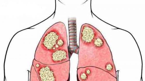 肺大泡能吸电子烟吗？