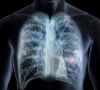 肺部手术后可以抽电子烟吗？