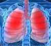 电子烟会不会造成肺水肿？