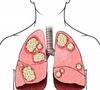 肺大泡可以吸电子烟吗？