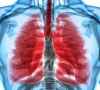 悦刻电子烟导致严重肺病？